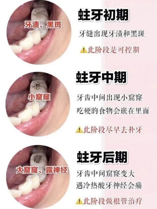 牙齿上刷不掉的黑线是什么?是蛀牙吗?