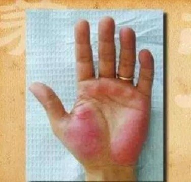 身上长了小红点,是肝病的表现吗?3个潜藏病因,了解一下