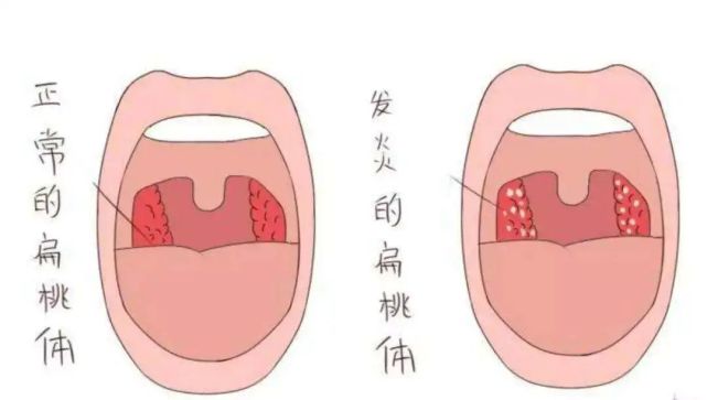 扁桃体:说出来怕吓着你