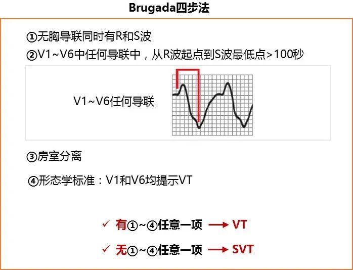 vereckei avr导联四步法判断标准