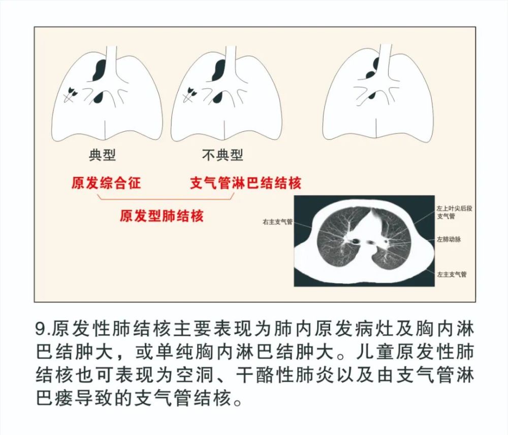 【图解疾病】结核病