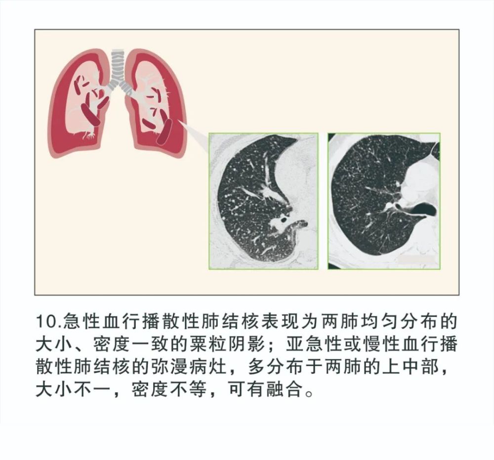 【图解疾病】结核病