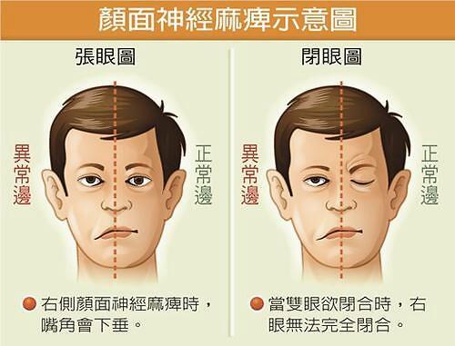 眼睑震颤|面瘫|园口|周围性面瘫|膝状神经节|角膜反射|病人|瘫痪