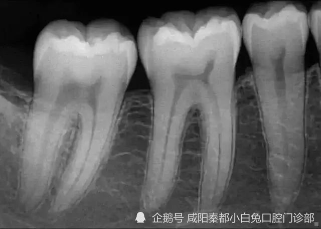 为什么要拍摄牙片?