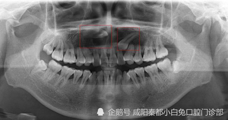 牙槽骨内是否有埋伏牙,多生牙,牙体组织有没有龋洞,牙根下有没有囊肿