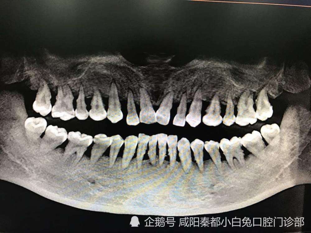 牙槽骨内是否有埋伏牙,多生牙,牙体组织有没有龋洞,牙根下有没有囊肿