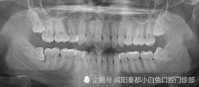 信不信一张牙片就能发现问题