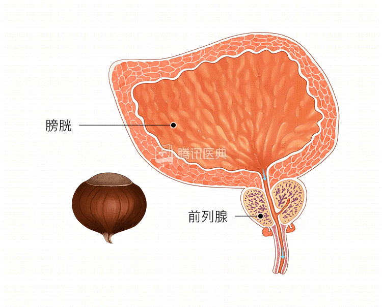 前列腺增生多起源于前列腺的移行带,但前列腺癌却最多见于外周带