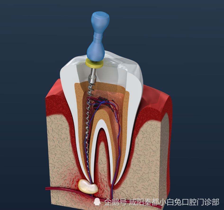 根管治疗的保护牙冠是什么?