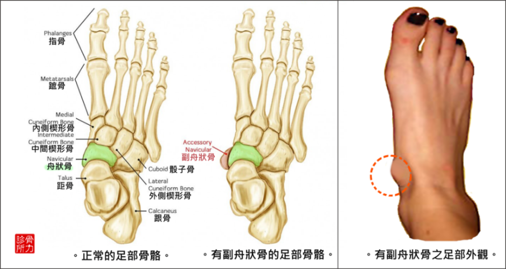 慢性内踝疼痛副舟状骨症候群