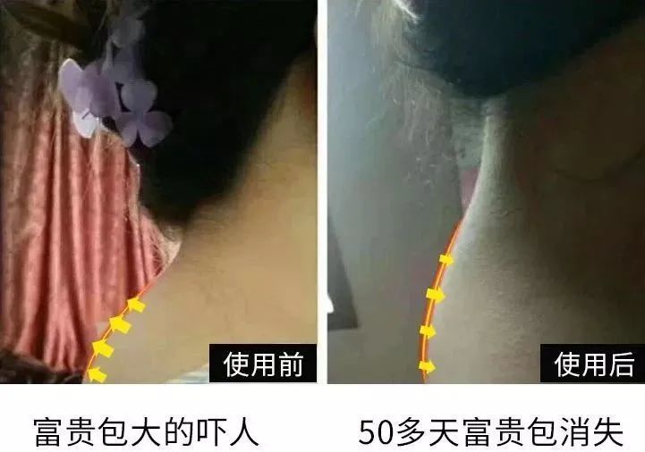 拍了ct图发现: 我拿给亲妈试用俩个月 脖子上那几十年的富贵包不见了