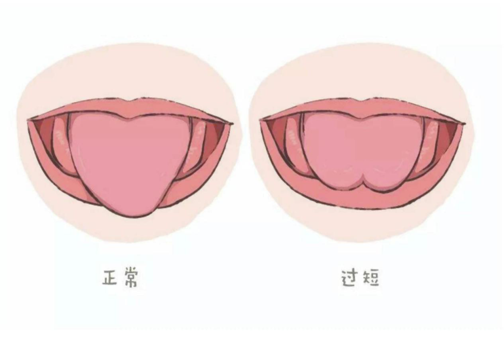 宝宝说话口齿不清就要剪舌系带