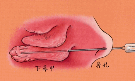 鼻甲肥大的病因及临床表现