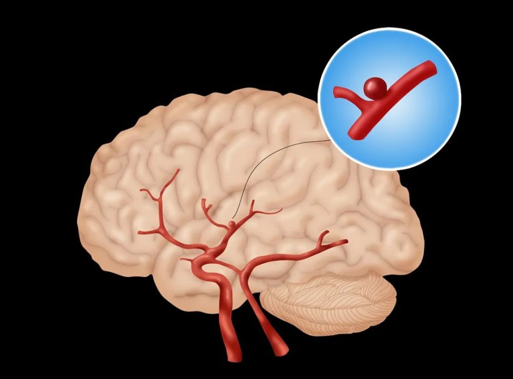 医者解读让拜登经历两次手术的脑动脉瘤是脑瘤吗