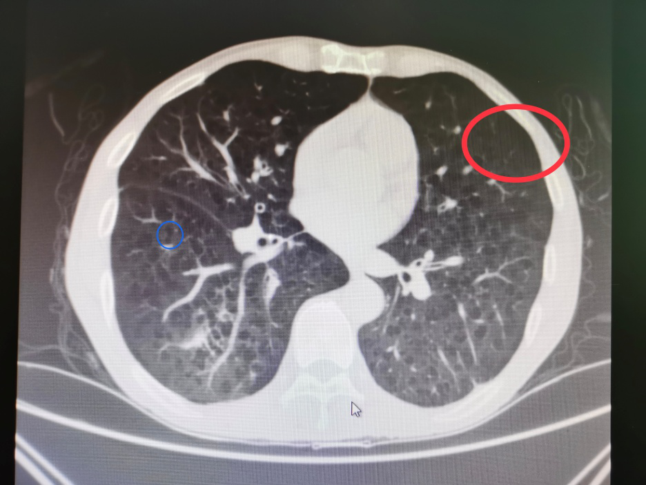 王嗲嗲肺部ct影像显示有肺气肿(红色圆圈)与肺大泡(蓝色圆圈)