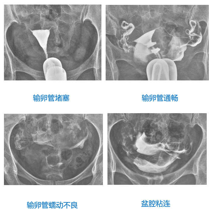 造影什么成语_正常输卵管造影图片(2)