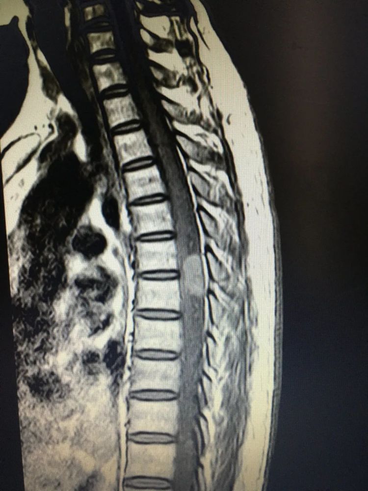 成功为一位高位胸椎硬膜内肿瘤患者施行后路胸椎体硬膜内血管瘤摘除
