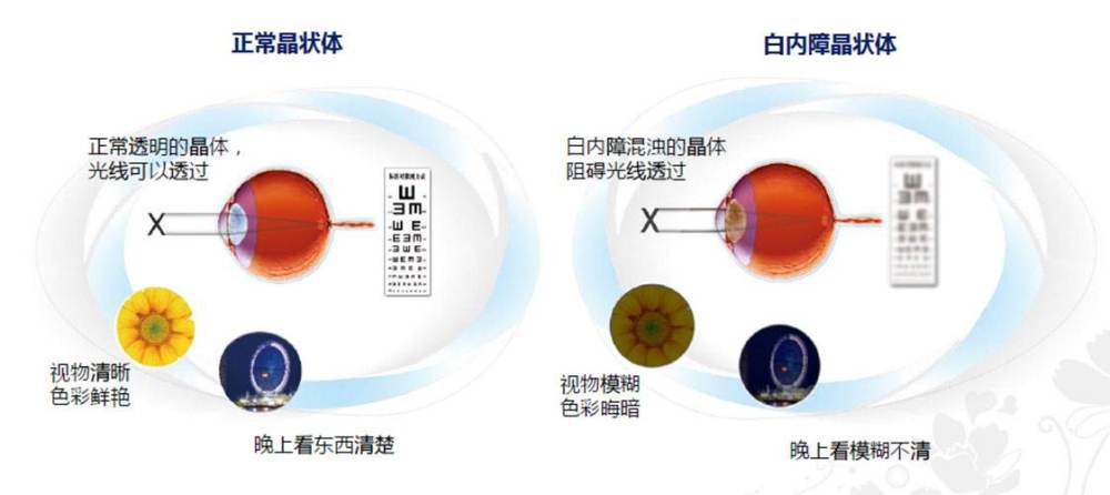 营养障碍和代谢失常而逐渐发生混浊,视力逐渐减退产生并发性白内障