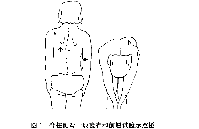 看两个肩膀是不是等高,两个肩胛骨下角是不是等高,两个腰窝是不是对称