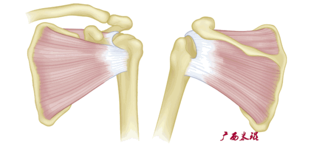 肩关节mri解剖肩袖损伤诊断技巧