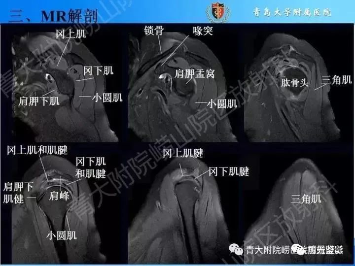 cuff)损伤由smith于1834年发现并命名,指组成肩袖的冈上肌,冈下肌