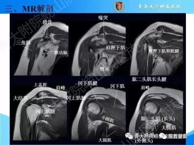 肩关节mri解剖肩袖损伤诊断技巧-对应动图,效果超赞