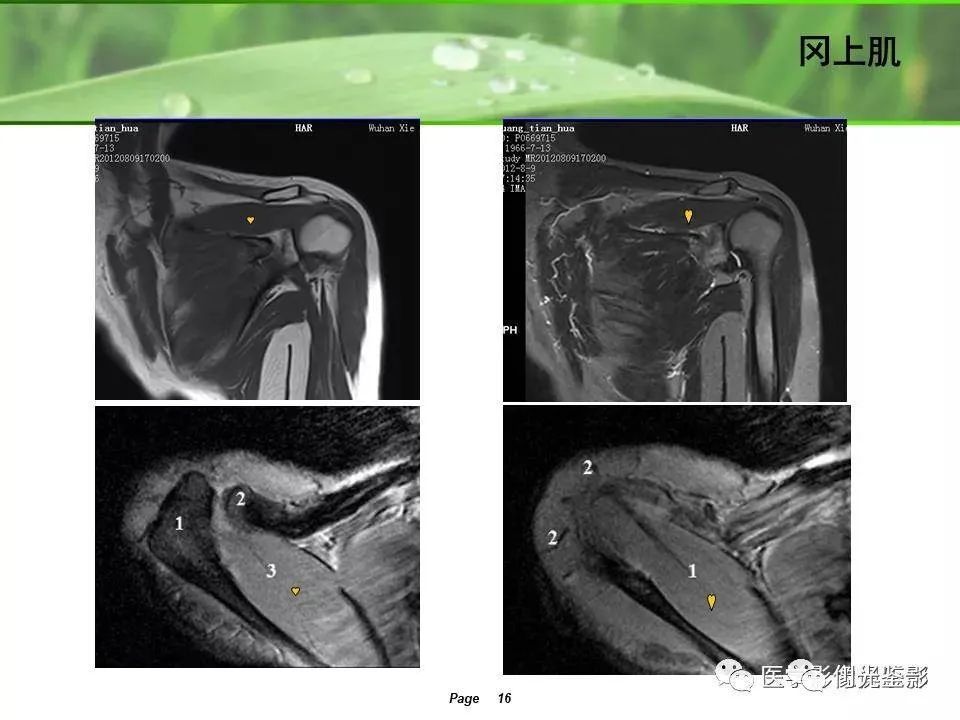肩关节mri解剖肩袖损伤诊断技巧