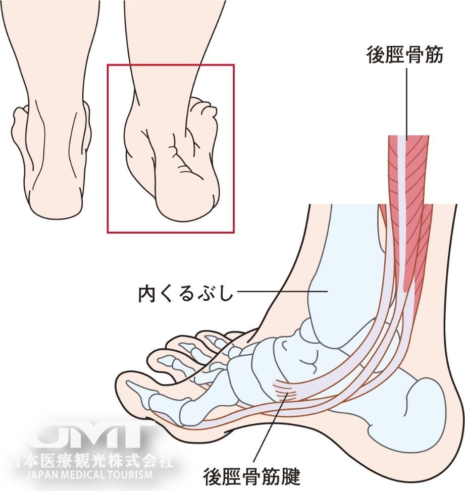 中老年女性常见的内脚踝疼痛由于加龄和扭伤引起的胫后肌腱功能障碍
