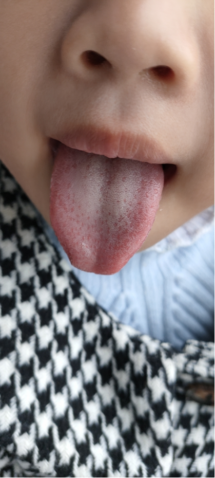 舌苔发红,上面有小红点是怎么回事?