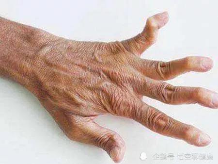 让我们一起学习和认识类风湿关节炎(四)