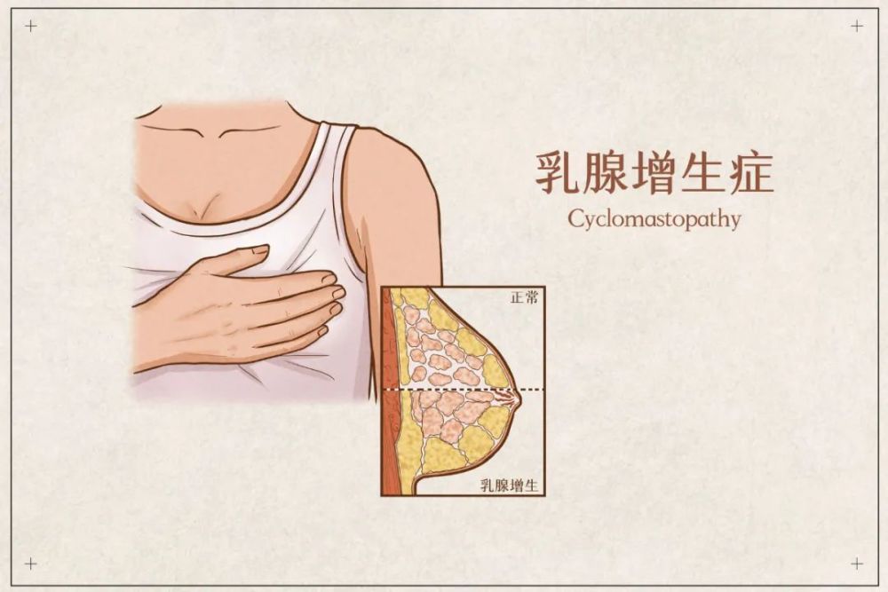 乳腺增生,试试这个经络处方