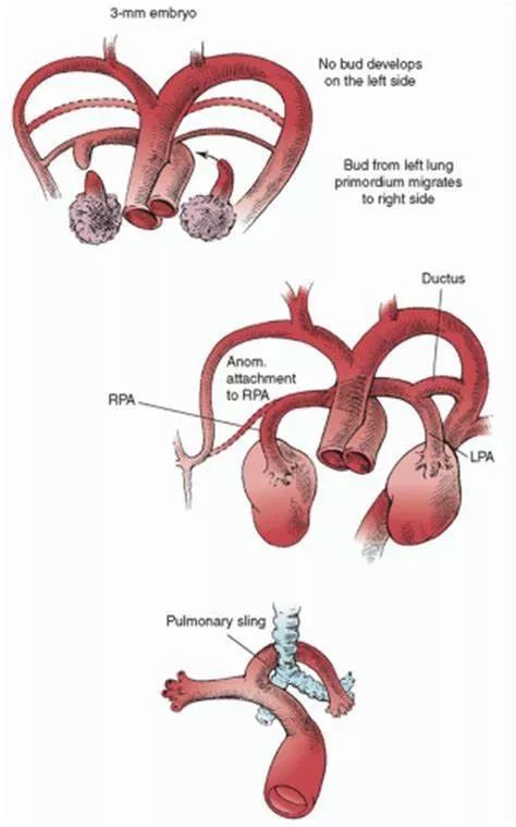 一起来认识肺动脉吊带的影像诊断与解剖模式