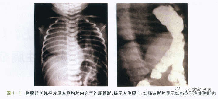 新生儿外科临床病例先天性膈疝