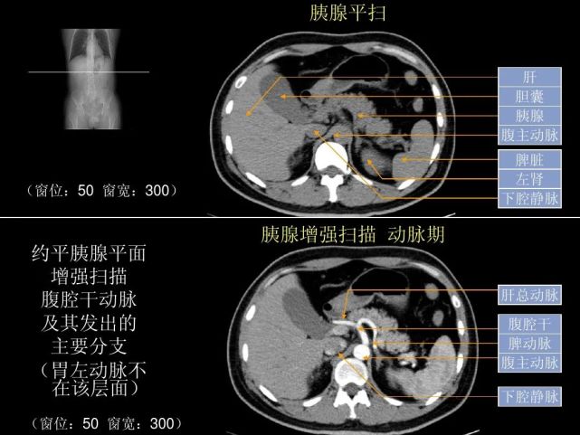 腹部ct入门解剖图谱,收藏版