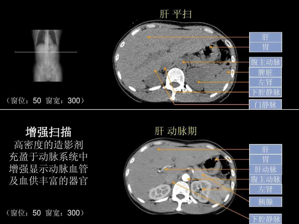 ct入门:腹部ct应用入门必备(原理 精美解剖图谱)