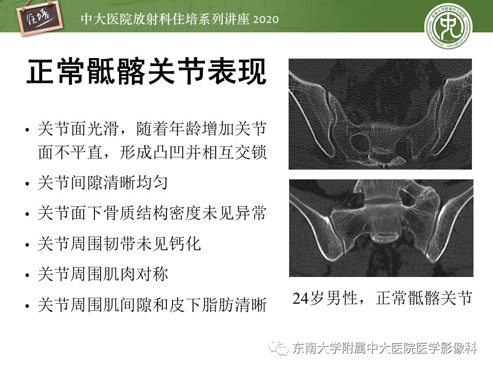 一文掌握|常见骶髂关节病变的影像表现