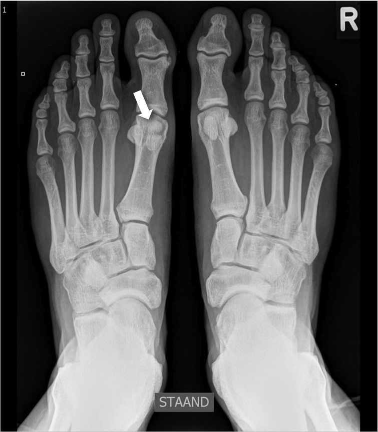 大脚趾的籽骨几乎总是存在; 它们可以在第一跖骨头下面找到,嵌入屈