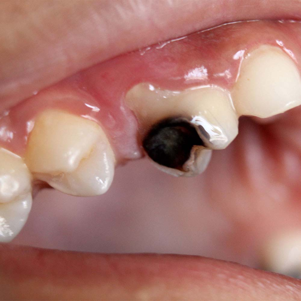 龋齿,其本质是牙齿硬组织发生了细菌性感染,最终导致牙体崩解形成窝洞