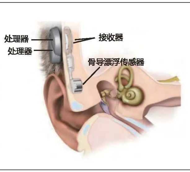 音书科普小众市场骨导助听