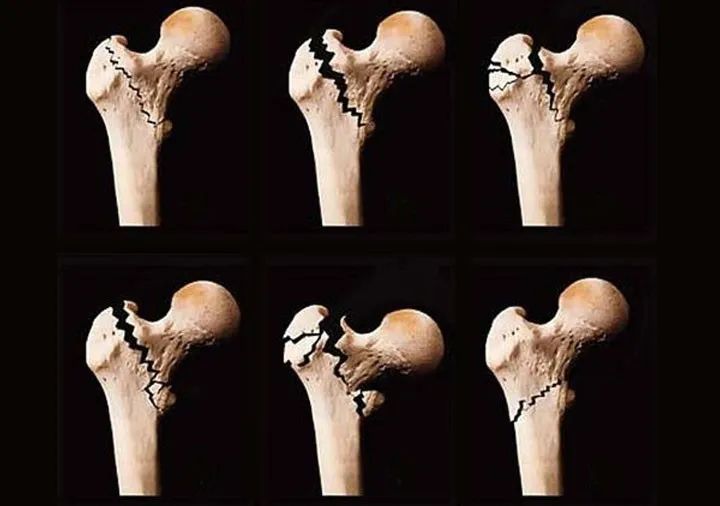 哪些外伤会引起股骨头坏死?