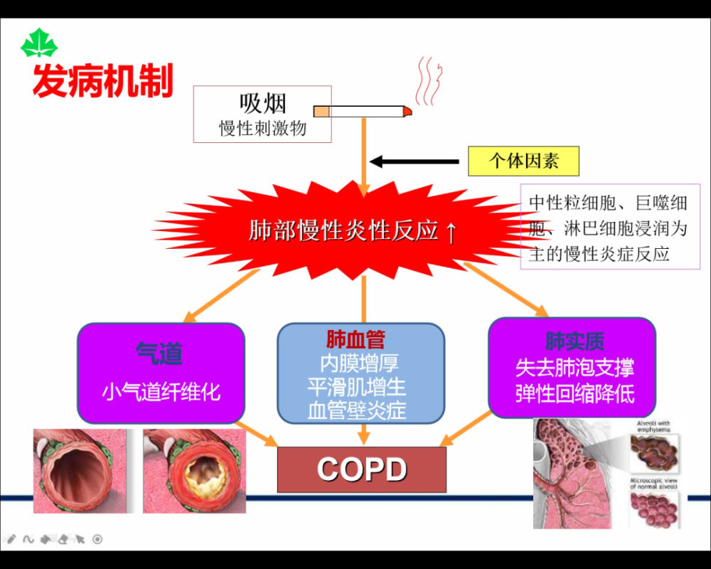 《健康一点点|有关慢阻肺的谣言