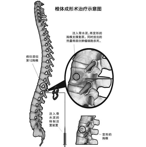 胸腰椎压缩性骨折?别怕!椎体成形术来了!