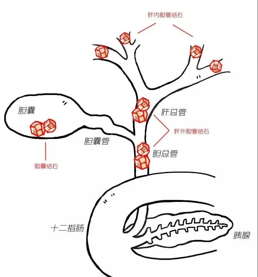 对不起这篇胆总管结石科普来晚了