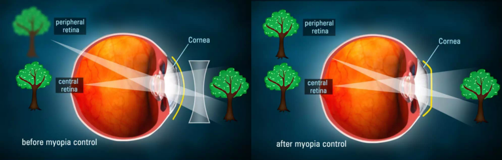 角膜塑形镜完美避免了配戴框架眼镜时在周边视网膜上形成的远视性离焦