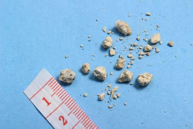 肾结石是什么?如果得了该怎么办?看过这篇文章就知道了