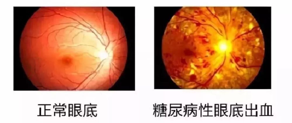 眼底出血的问题大不大?拖延不治可能会致盲!