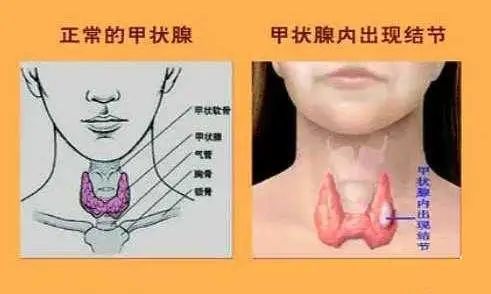 女性出现甲状腺结节之后通常都会表现为脖子肿大,有一些患者会明显的