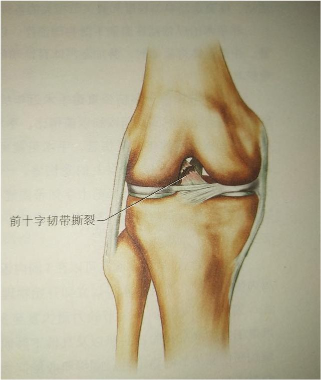 人体前十字交叉韧带损伤的治疗和康复!