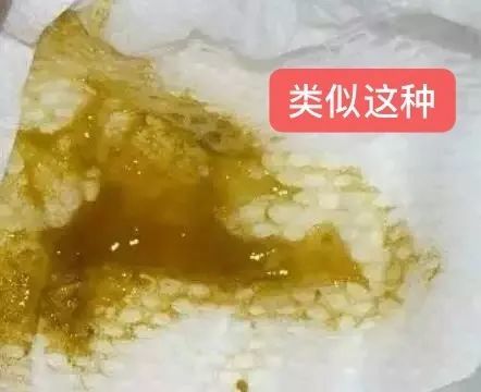 宝宝大便有粘液怎么回事是生病了吗一篇文章弄懂