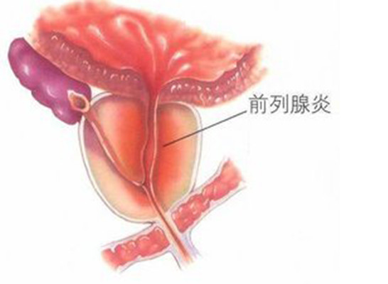 如何预防前列腺炎,如何预防前列腺炎和前列腺肥大